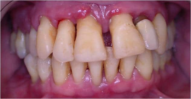Antes
